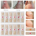 Effective Foot Corn Remover Plaster